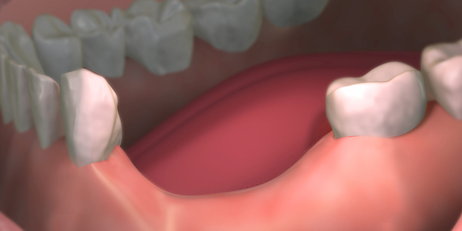 Tooth & Bone Loss Miami, FL Periodontst Dr. Ross