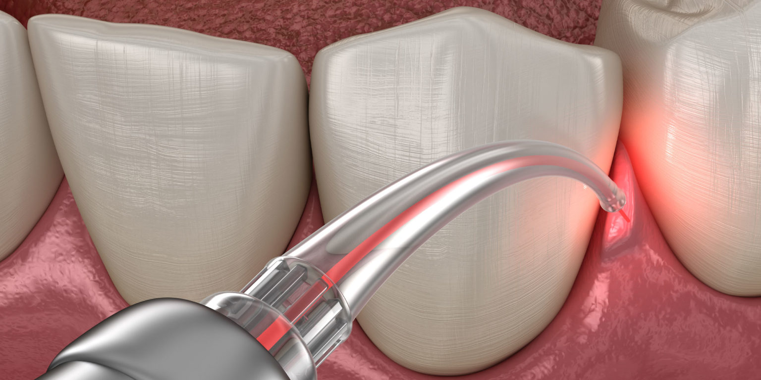 LANAP® Laser Gum Surgery - Miami, FL - Bleeding Gums