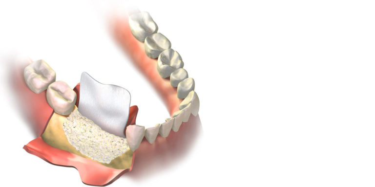 Guided Tissue Bone Regeneration Miami Fl Periodontists 